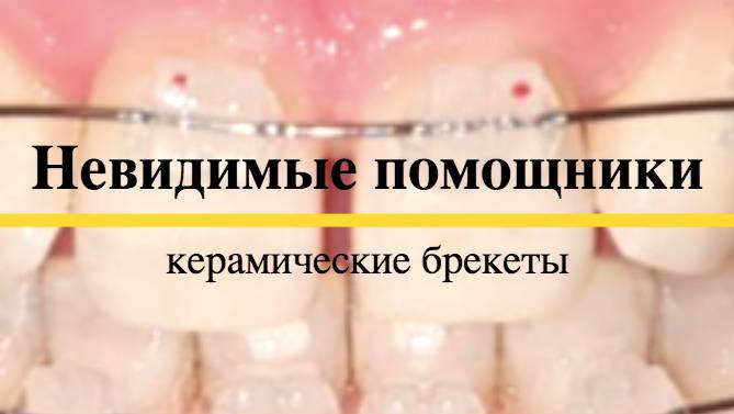 Невидимые помощники: керамические брекеты
