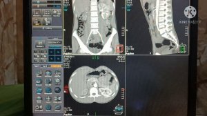 CT Renal Angiography In Hindi On Toshiba Aquilion 64 Slice. गुर्दे की एंजियोग्राफी कैसे करें.