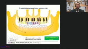 59. Рекомендации по планированию лечения на имплантатах