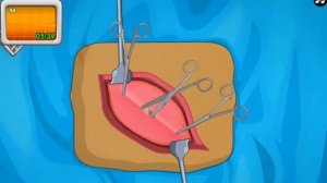 Вторая операция #2.Удаляем апендицит.