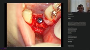 35. ''Тактика при узком альвеолярном гребне. Расщепление гребня.''(01.10.2019)