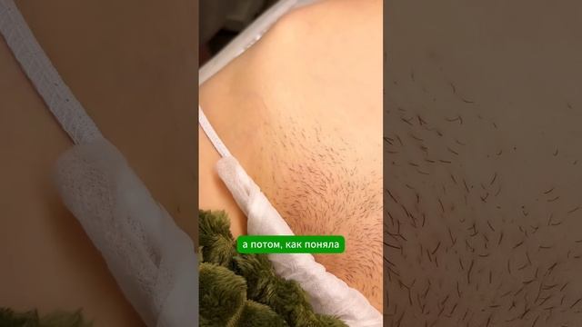 Запись на электроэпиляцию через wa 79688033388 #электроэпиляциямосква #электроэпиляция