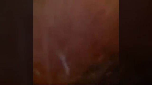 C41 Flexible Video Cystoscope-Clinical Application смотреть онлайн