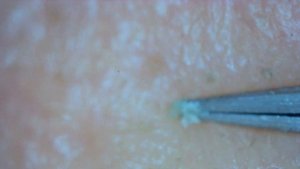 0246 keratin plug removal nose