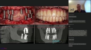03. Вебинар «Тотальное протезирование беззубой челюсти»