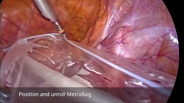 BOWA - MetraBag for morcellation смотреть онлайн