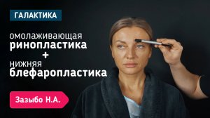 Омолаживающая ринопластика + нижняя блефаропластика | Зазыбо Николай Александрович