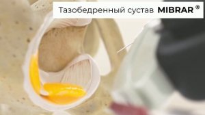 Лечение тазобедренного сустава без операции #Mibrar #регенеративнамедицина