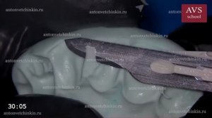 Восстановление латерального резца