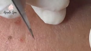 Relax every day with Apple Spa - Squeeze acne blackheads #30