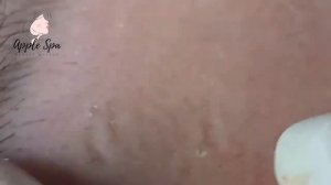 Relax every day with Apple Spa - Squeeze acne blackheads #29