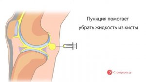 Пункция кисты Бейкера в клинике Стопартроз