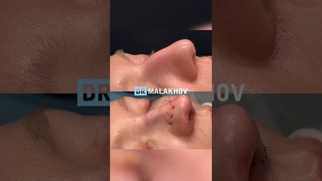 Первичная риносептопластика 🔥