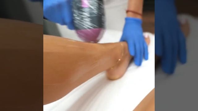 Лазерная эпиляция