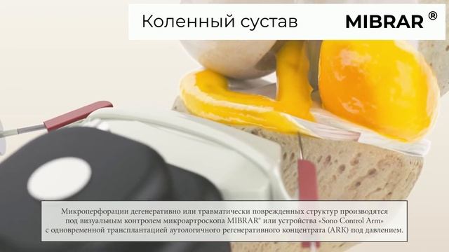 Лечение  коленного сустава без операции