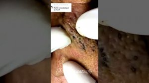 Huge blackheads extraction Pimple popper blackhead on face