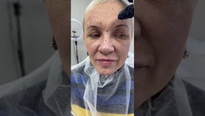 Ботокс до после