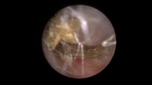 OUR BIGGEST EAR WAX & SKIN REMOVAL EVER! 2020 - EP 302