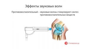 Ударно-волновая терапия (УВТ) в клинике Стопартроз