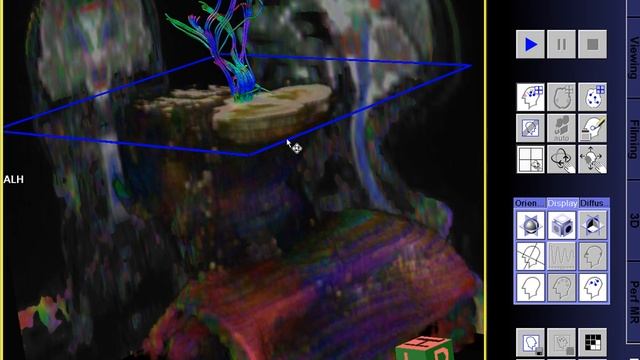 Cspine Head DTI - 1.5T Siemens Aera MRI смотреть онлайн