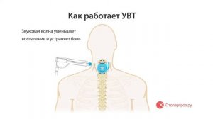 Ударно-волновая терапия шейного отдела позвоночника