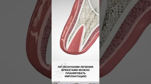 Установка базальных  имплантатов и брекеты – возможно? Ответ от стоматолога-хирурга, основателя ИБИ