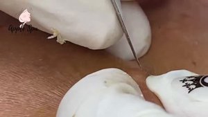 Relax every day with Apple Spa - Squeeze acne blackheads #33