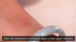 Plasma Pen Skin Tag & Mole Remover | Fibroblast Skin Tightening