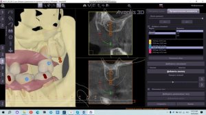 Расстановка минивинтов и резиновых тяг