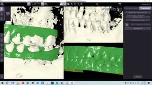 Совмещение сканов и КТ