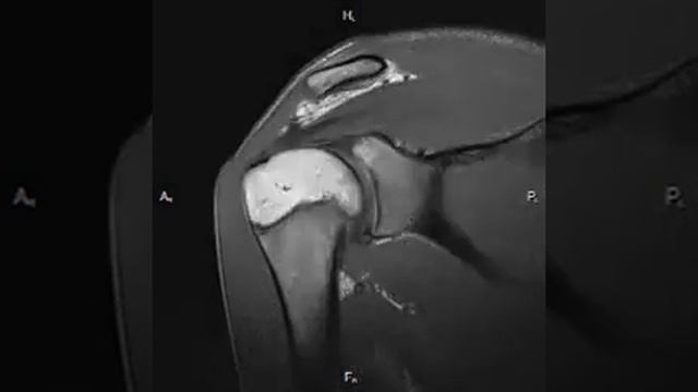 МРТ плечевого сустава на МРТ 1.5 Тесла Siemens Magnetom Avanto смотреть онлайн