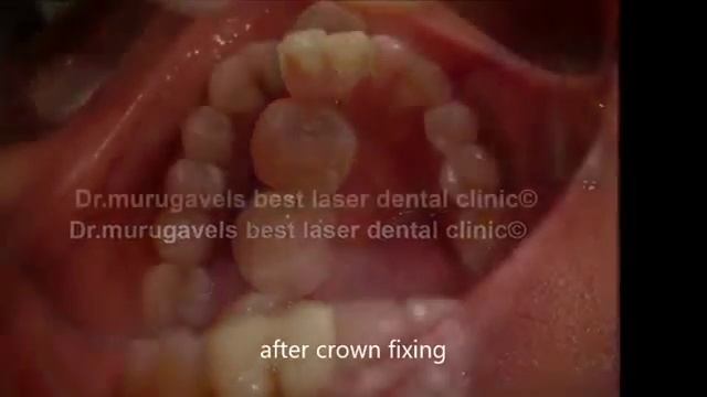 Single Lower molar implant with zirconium crown смотреть онлайн