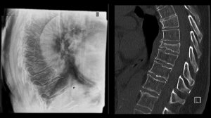 Interview on Tomosynthesis with Dr. D. Lommel, Radiology Department Wittlich Hospital, Germany