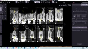 Просмотр КТ зубов