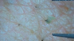 0254 keratin plug removal nose