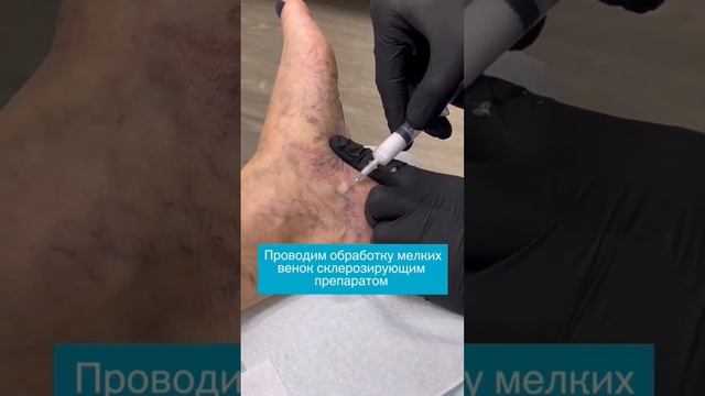 Склеротерапия - удаление сосудистой сетки на голеностопе в Центре флебологии.