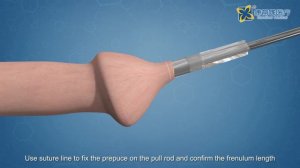 Condiner Disposable Circumcision Stapler