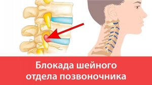 Блокада шейного отдела позвоночника