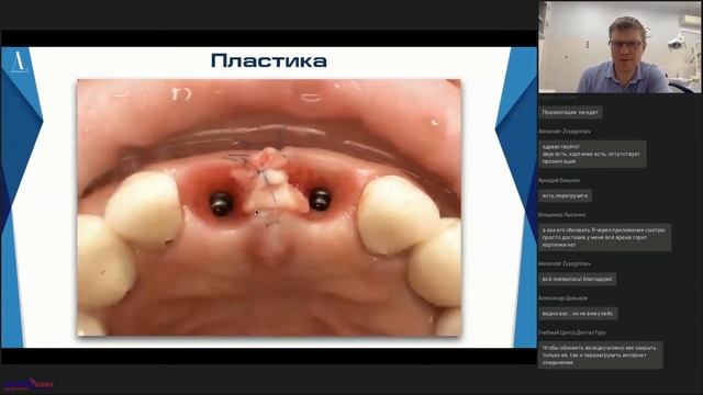 36. Каркасная аугментация мягких тканей. Аналоговый и цифровой подход. Вебинар