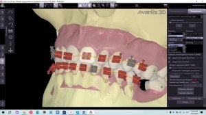 Расстановка брекетов