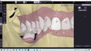 Шаблон для брекетов