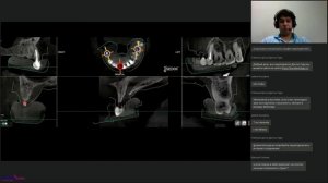 24. Нюансы навигационного планирования дентальной имплантации. Как избежать ошибок_