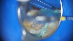 эндодонтия 26