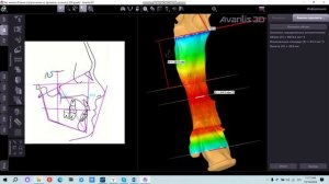 Анализ верхних дыхательных путей