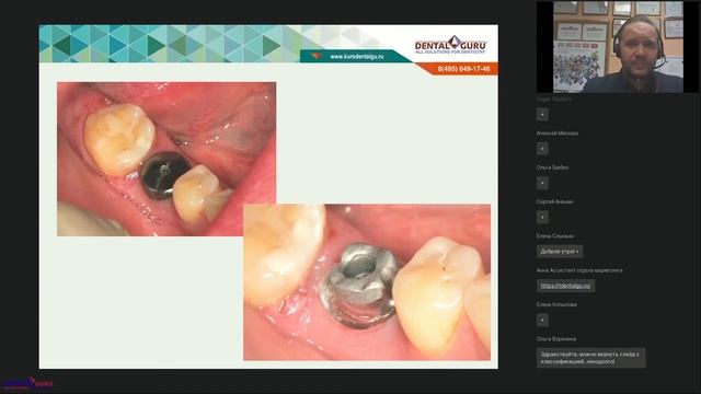 45. Протезирование на имплантатах.  Клинические аспекты выбора абатментов