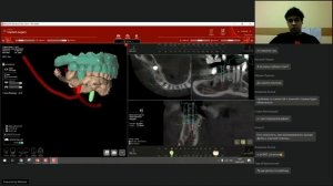 03. Особенности работы с программным обеспечением КЛКТ при планировании имплантации