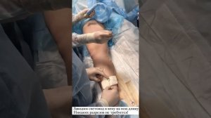 ЭВЛО Удаление варикоза без операции за один день. Флебология Москва