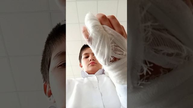 сломал палец