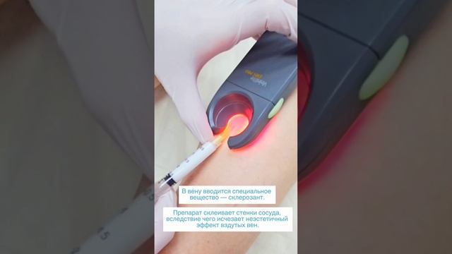 Избавиться от сосудистой сетки на ногах и не носить компрессию? Сеанс #клакс-теарпии на лазере⤵️