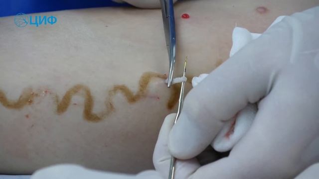 Минифлебэктомия в ЦИФ комментирует Соломахин А.Е.